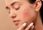 Беттегі безеуден (акнеден) арылу