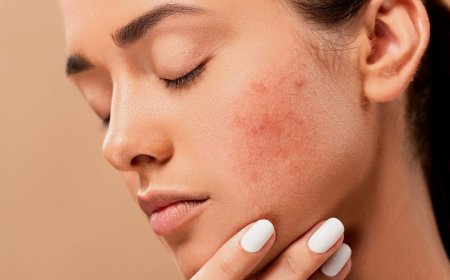 Беттегі безеуден (акнеден) арылу