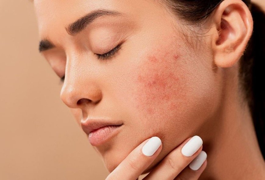 Беттегі безеуден (акнеден) арылу