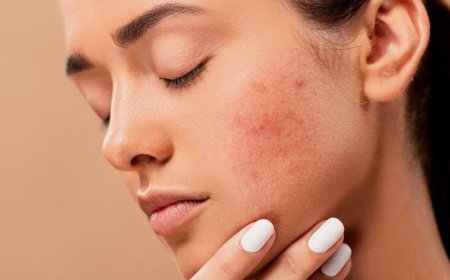 Getting Rid of Facial Acne (Acne Treatment & Prevention)