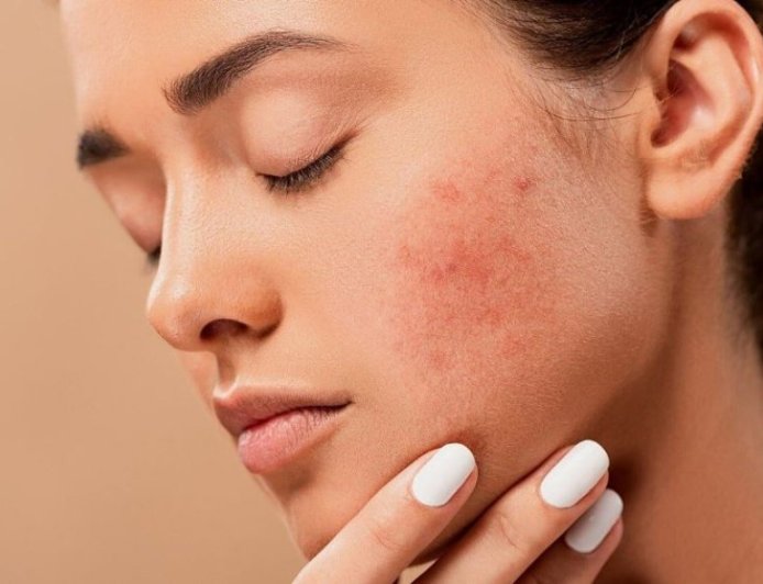 Menghilangkan jerawat di wajah